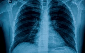 close up chest xray