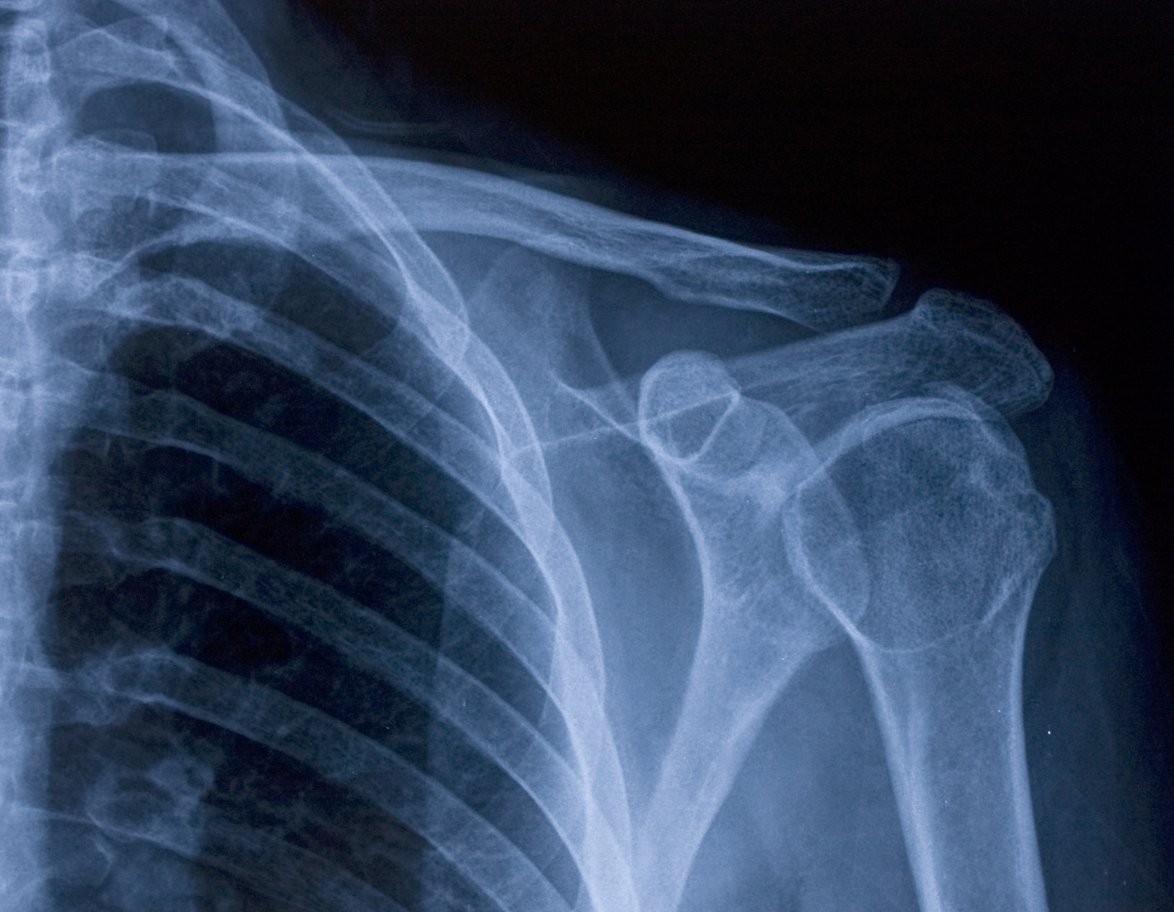 a close up of a shoulder xray