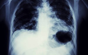A chest xray focused on the lungs