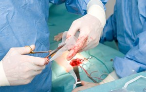Surgeons preparing a mesh implant
