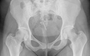 an xray of pelvis