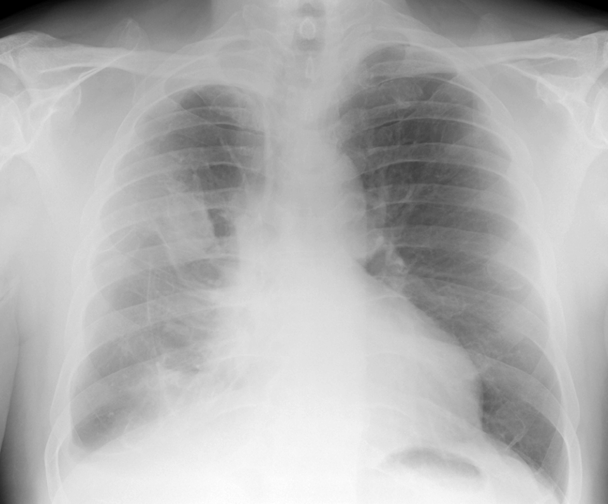 a chest xray showing lungs and ribs